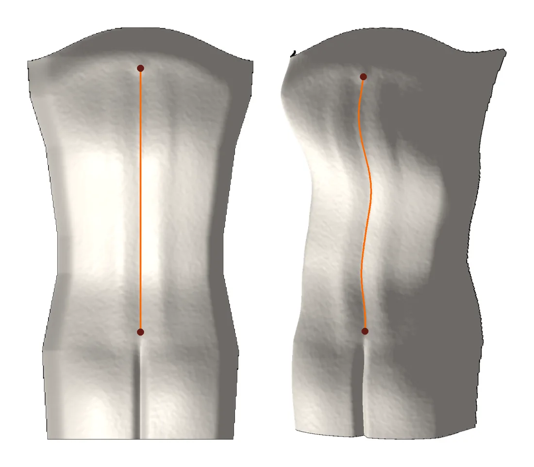 3D back scan with the spine line: a straight spine and a scoliosis